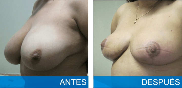 Reducción con levantamiento mamario - Caso 4
